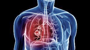 Quantifying Chronic Obstructive Pulmonary Disease